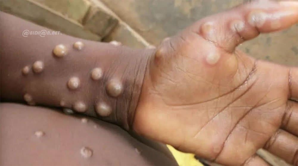 Côte d’Ivoire : Variole de Singe, six cas détectés dont une guérison enregistrée, selon le gouvernement